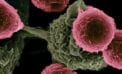 cancer cells New targets found for diagnosing, treating aggressive cancers
